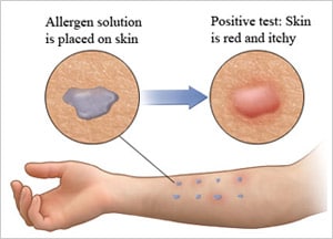 allergy test